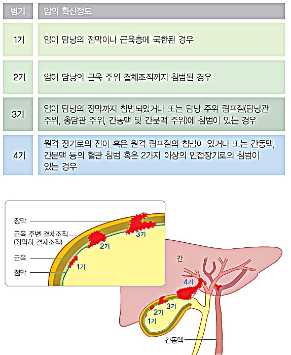 담낭암 3기의 치료법은?